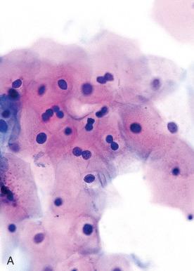 Fig. 13.10, Abnormal parakeratosis and abnormal keratinizing cells. A and B, Binucleation and more subtle differences in nuclear size and staining intensity in mature cells are generally more common in low-grade squamous intraepithelial lesion (LSIL). C and D, More pronounced nuclear disturbances with coarse chromatin raise the possibility of high-grade squamous intraepithelial lesion (HSIL). E and F, Striking abnormalities in nuclear contour and chromasia coupled with dense cytoplasmic keratinization characterize HSIL and may be associated with invasive carcinoma.