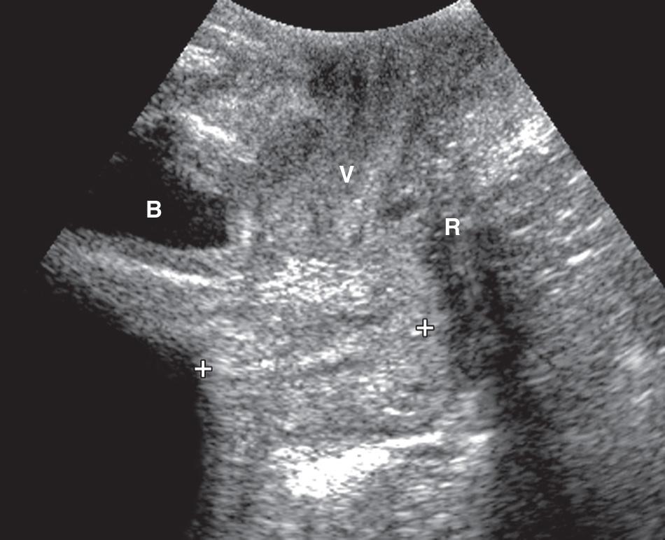 FIG. 44.3, Transperineal Scan of Normal Cervix.