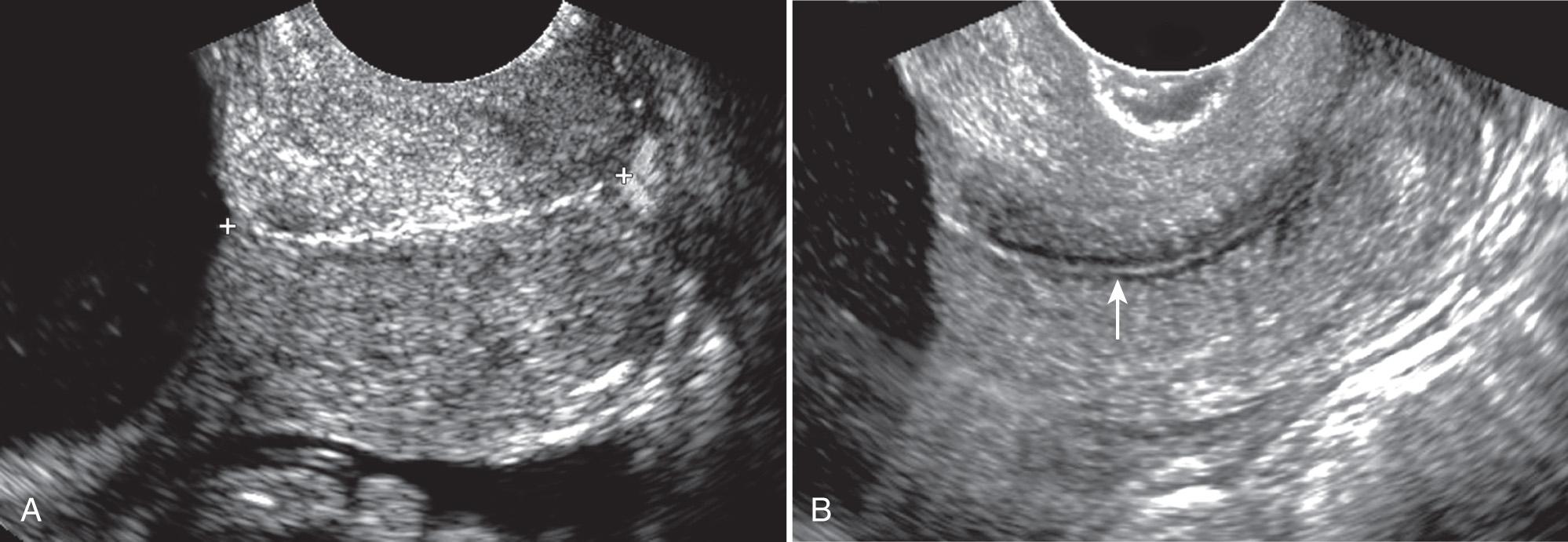 FIG. 44.4, TVS of Normal Cervix.