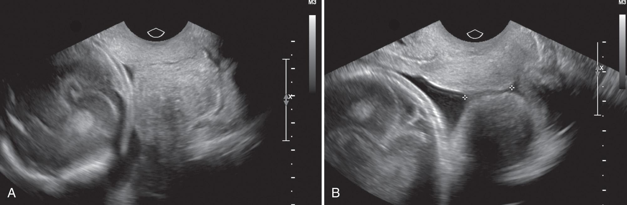 FIG. 44.5, Example of Poor Technique During TVS of Cervix.