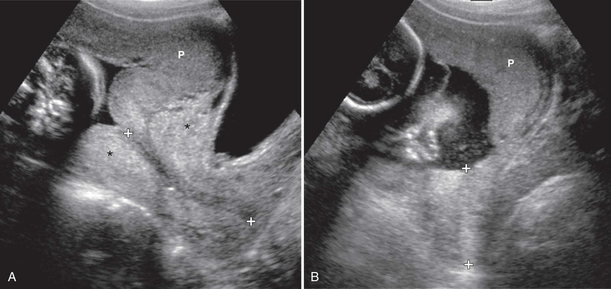 FIG. 44.6, Uterine Contractions.