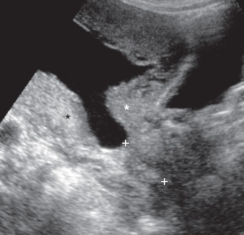 FIG. 44.7, Pseudodilation Caused by Uterine Contractions.