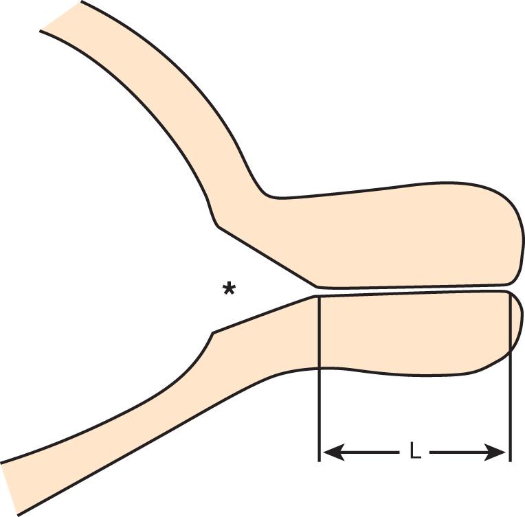 FIG. 44.10, Schematic of Abnormal Cervix.