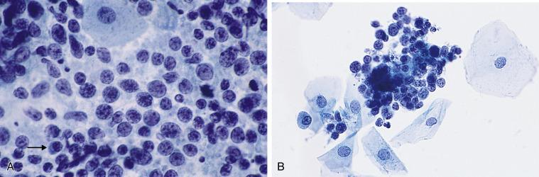 Fig. 1.16, Follicular Cervicitis.