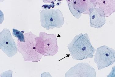 Fig. 1.4, Superficial and Intermediate Squamous Cells.