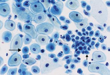 Fig. 1.5, Parabasal and Basal Cells (postpartum smear).