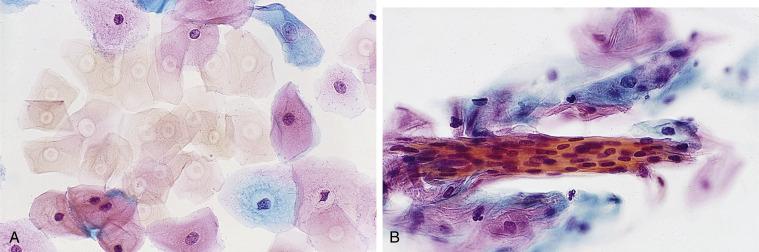 Fig. 1.9, Keratosis.