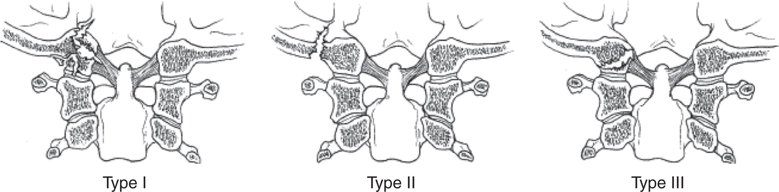 FIGURE 2, Types of occipital condyle fractures.