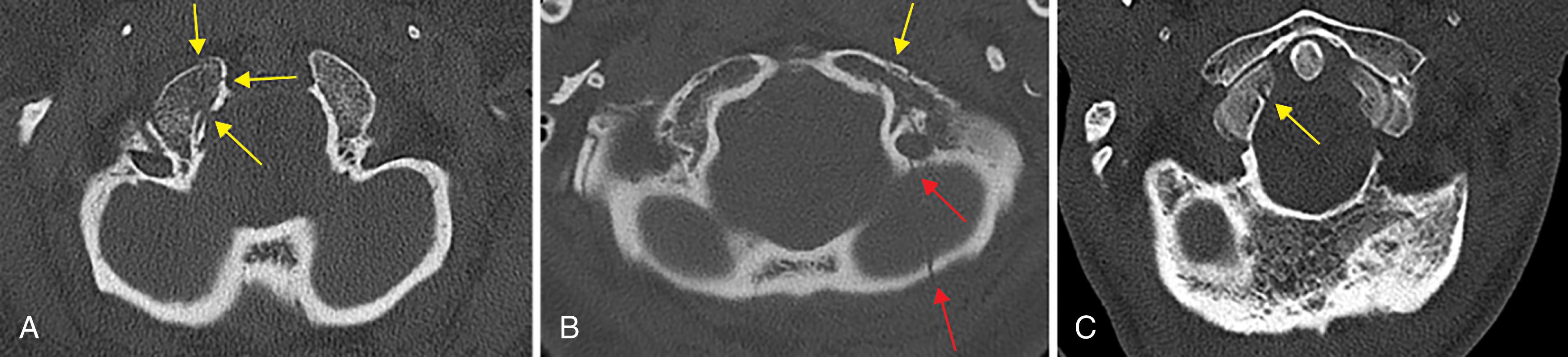 FIGURE 3, Occipital condyle (OC) fractures. Axial CT images of the skull base demonstrate a comminuted impacted fracture of the right OC (A), a left skull-base fracture ( red arrows ) extending to involve the ipsilateral OC (B), and an avulsion fracture of the right OC (C).