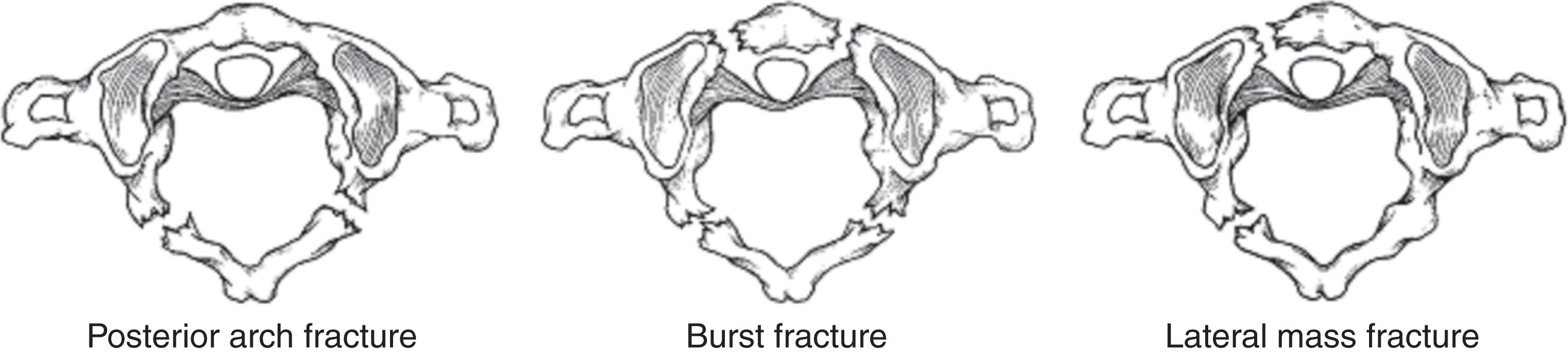 FIGURE 5, Types of C1 arch fractures.