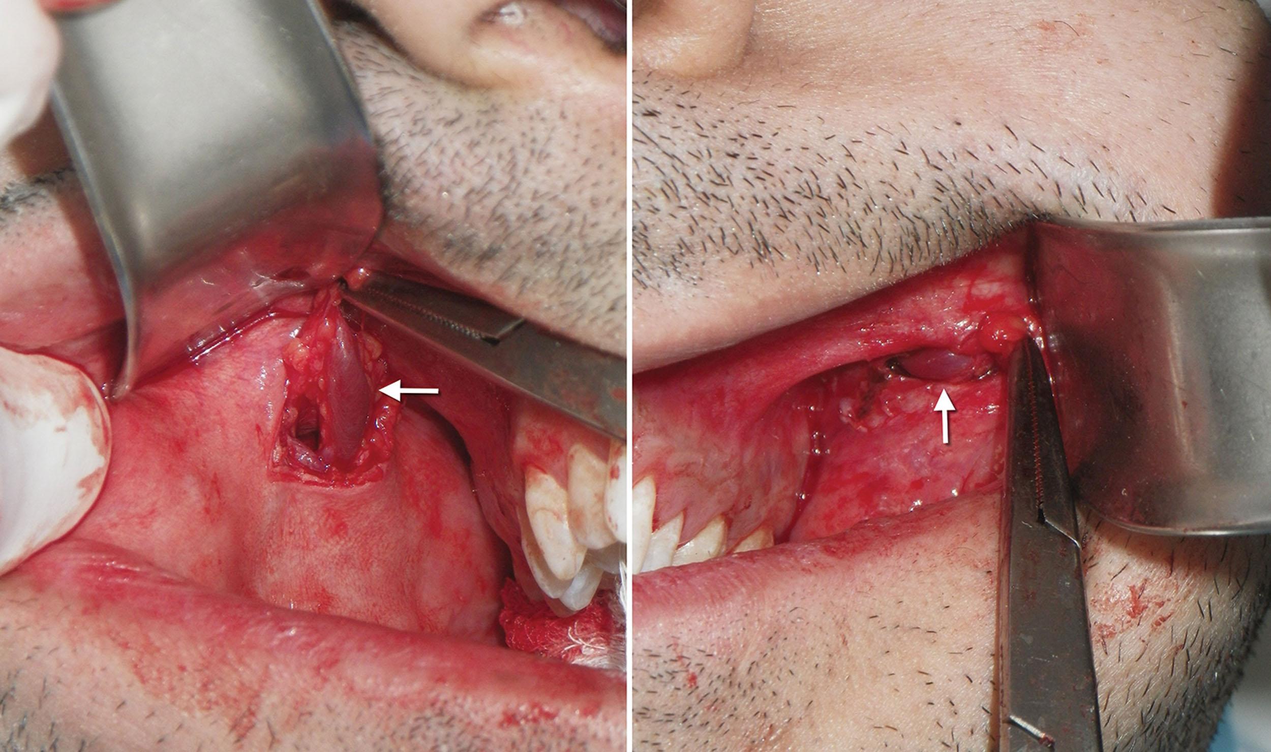 Fig. 15.14, The parotid duct on each side is shown in the same patient. It is usually not visualized but may present when performing larger incisions.