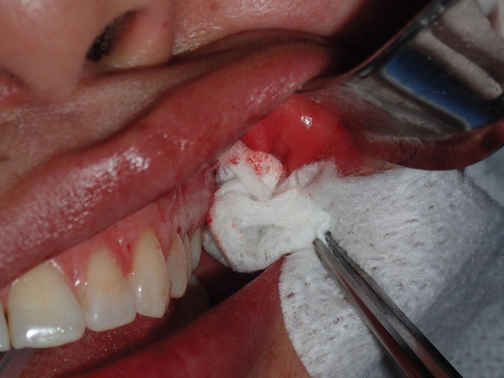 Fig. 15.36, Hemostatic (combat) gauze is placed through the incision to pack the surgical site for hemostasis.