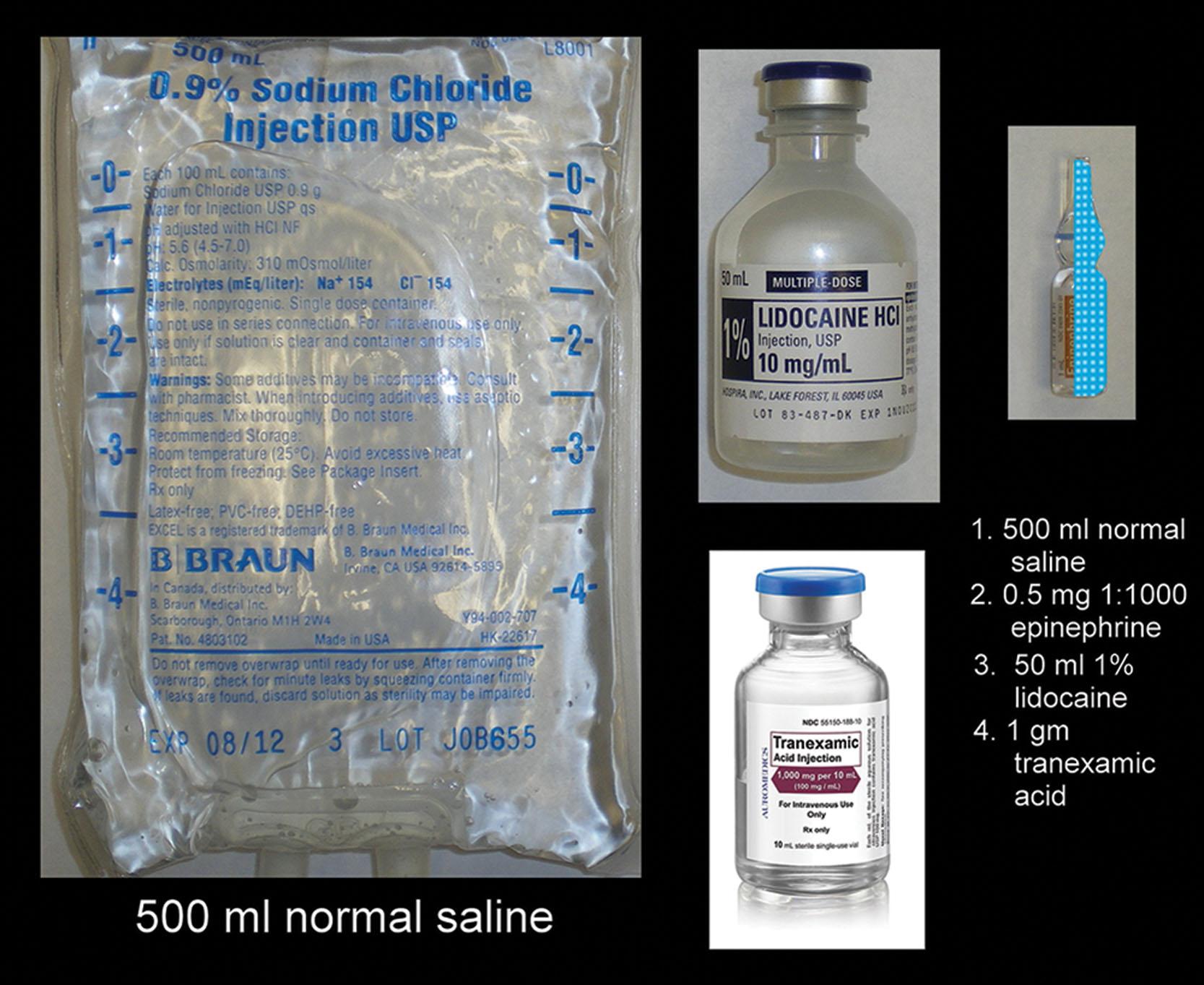 Fig. 15.41, A 500-mL volume of tumescent anesthesia is mixed by using 500 mL of normal saline with one 0.5 g of lidocaine (50 mL of 1% lidocaine) and 0.5 mg of epinephrine (½ ampule of epinephrine 1:1000); 500 mg of tranexamic acid is also added. This volume is usually adequate for facial liposuction and prevents wasting an entire liter of traditionally mixed tumescent anesthesia.