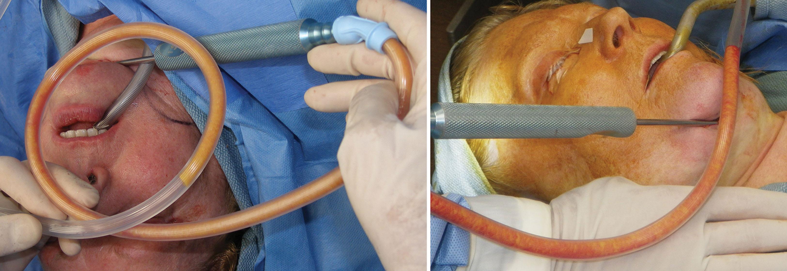 Fig. 15.55, Generous fat is removed from the submental area with a 6-mm liposuction cannula. Fat removal from this region varies from 5–30 mL in the average patient.