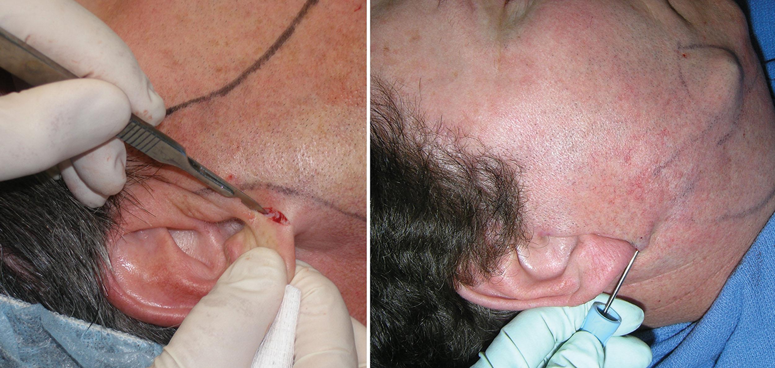 Fig. 15.60, An earlobe incision is made at the junction of the lobe and cheek, and the cannula is advanced without suction until the jowl is reached. It is important not to use active suction while advancing to the jowl, or a groove can be created along the mandibular border.