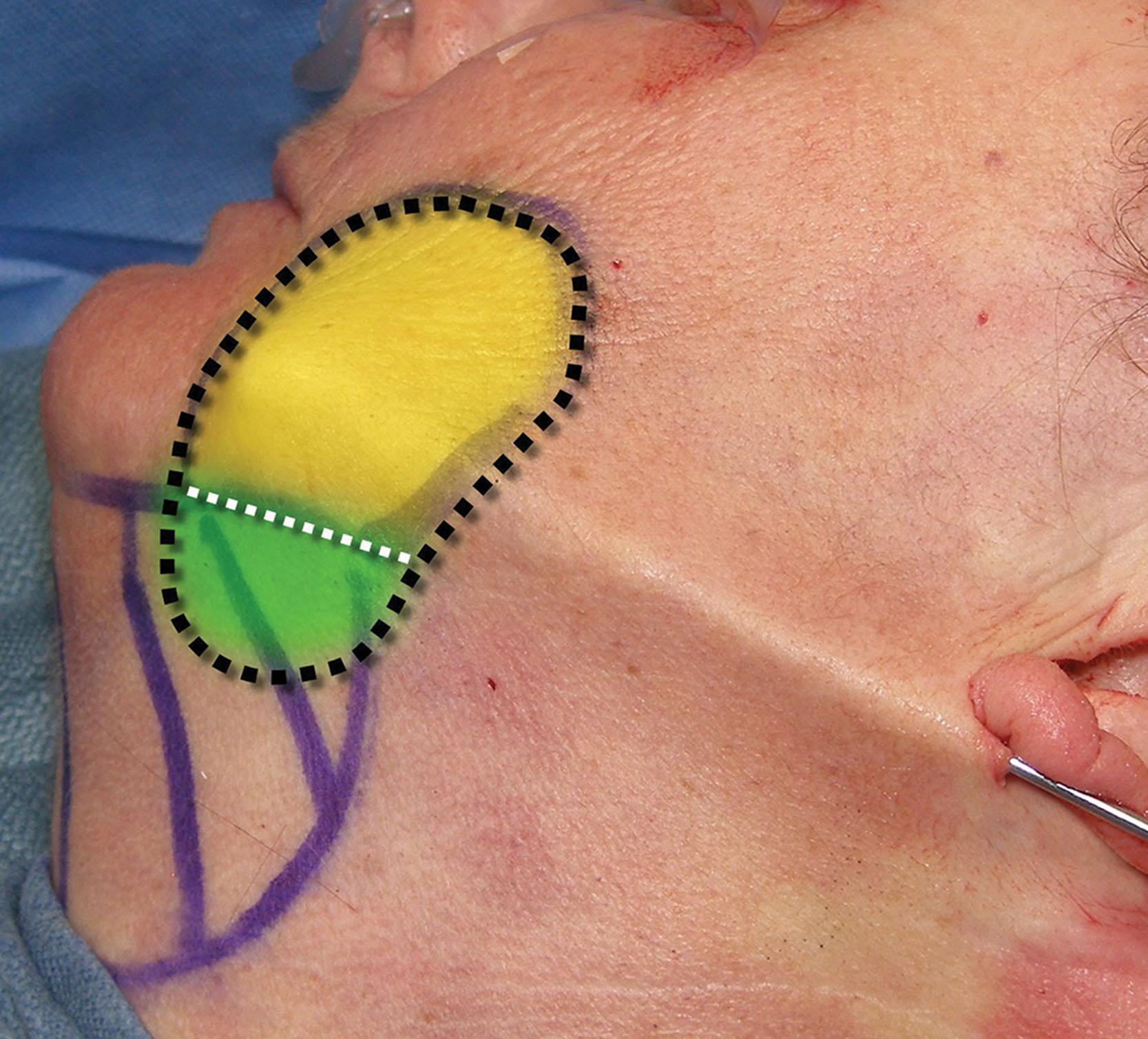 Fig. 15.61, The jowl can extend above (yellow) and below (green) the mandibular border (white line) . It is important to address the inferior fat below the mandibular border as well.