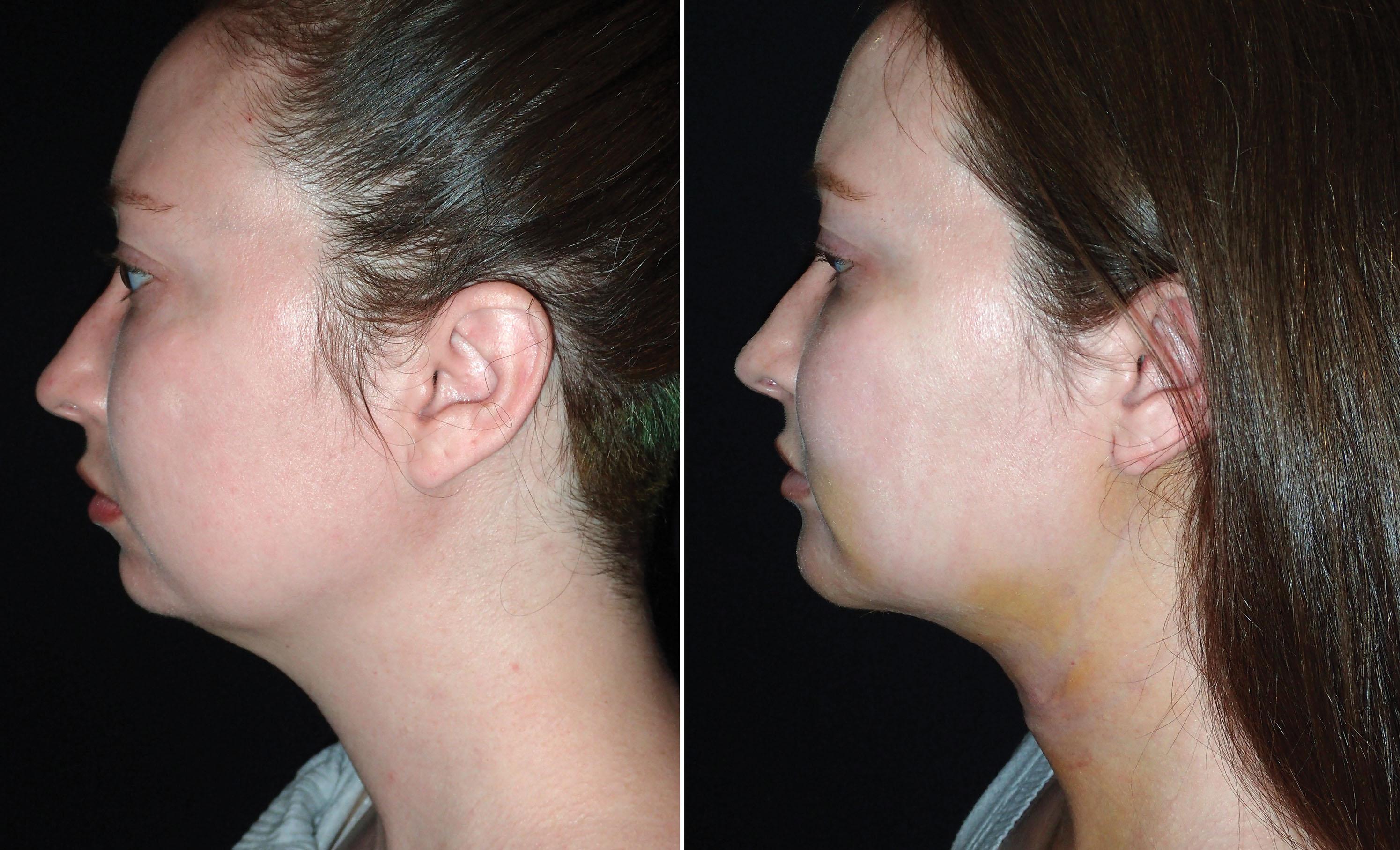 Fig. 15.69, This patient underwent cervicofacial liposuction with a simultaneous chin implant. She is shown 5 days after the procedure.