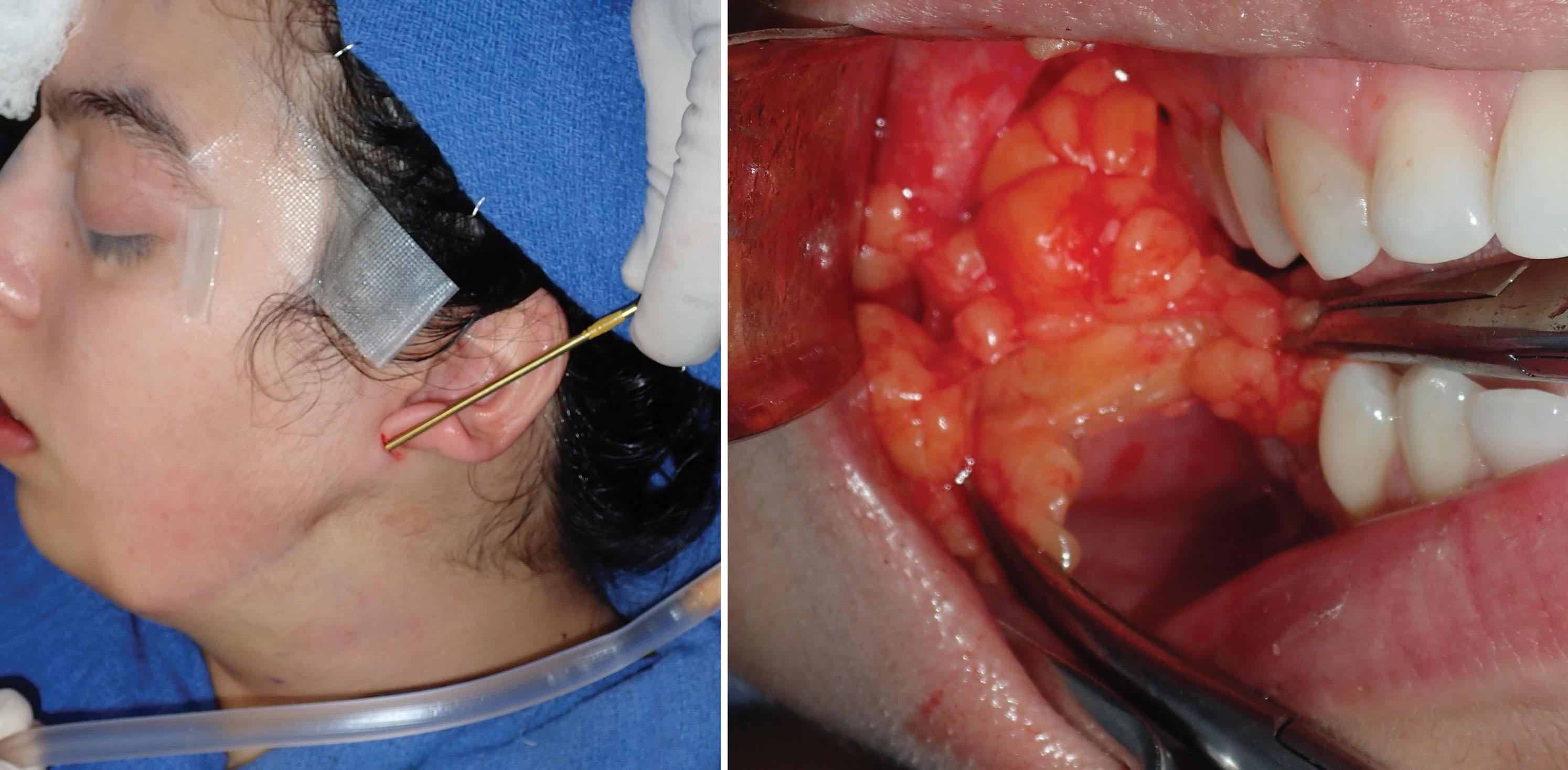 Fig. 15.74, Buccal fat pad reduction in jowl liposuction are commonly performed at the same time as a classic submentoplasty.