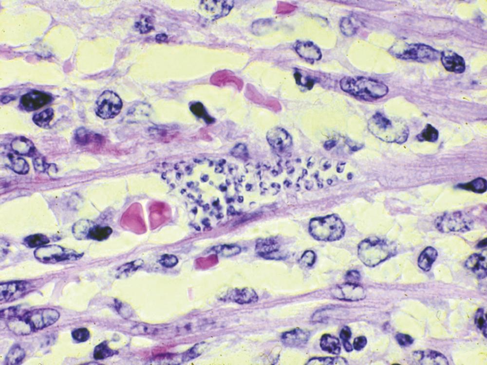 FIGURE 318-1, Trypanosoma cruzi in cardiac muscle of a child who died of acute Chagas myocarditis.