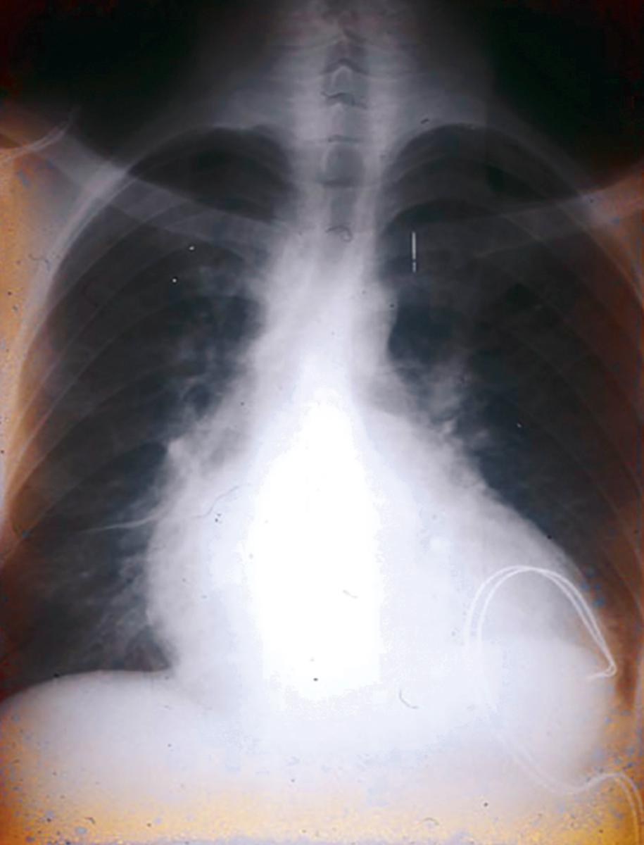 E-FIGURE 318-1, Chest radiograph of a patient from Bolivia with chronic Trypanosoma cruzi infection, rhythm disturbances, and cardiomyopathy.