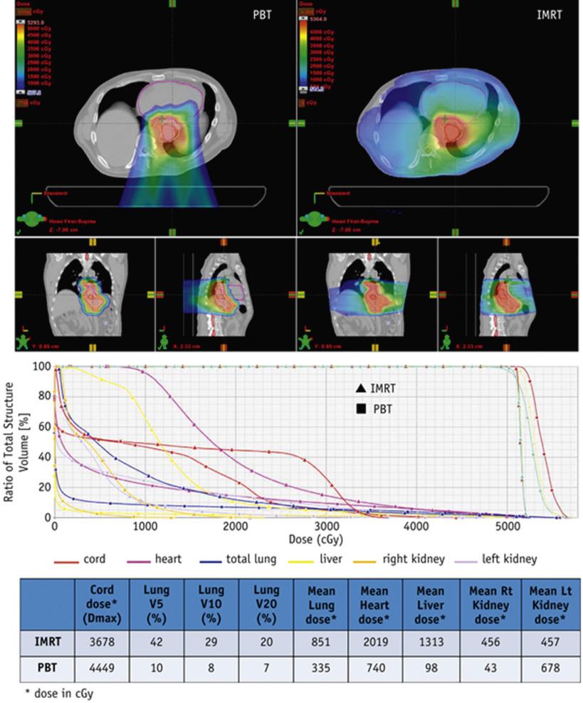 Fig. 24.3, Dosimetric comparison of proton therapy versus Intensity-modulated radiation therapy (IMRT) for a distal esophageal cancer demonstrating significant normal tissue sparing with proton therapy, particularly to the lung, heart, and liver.