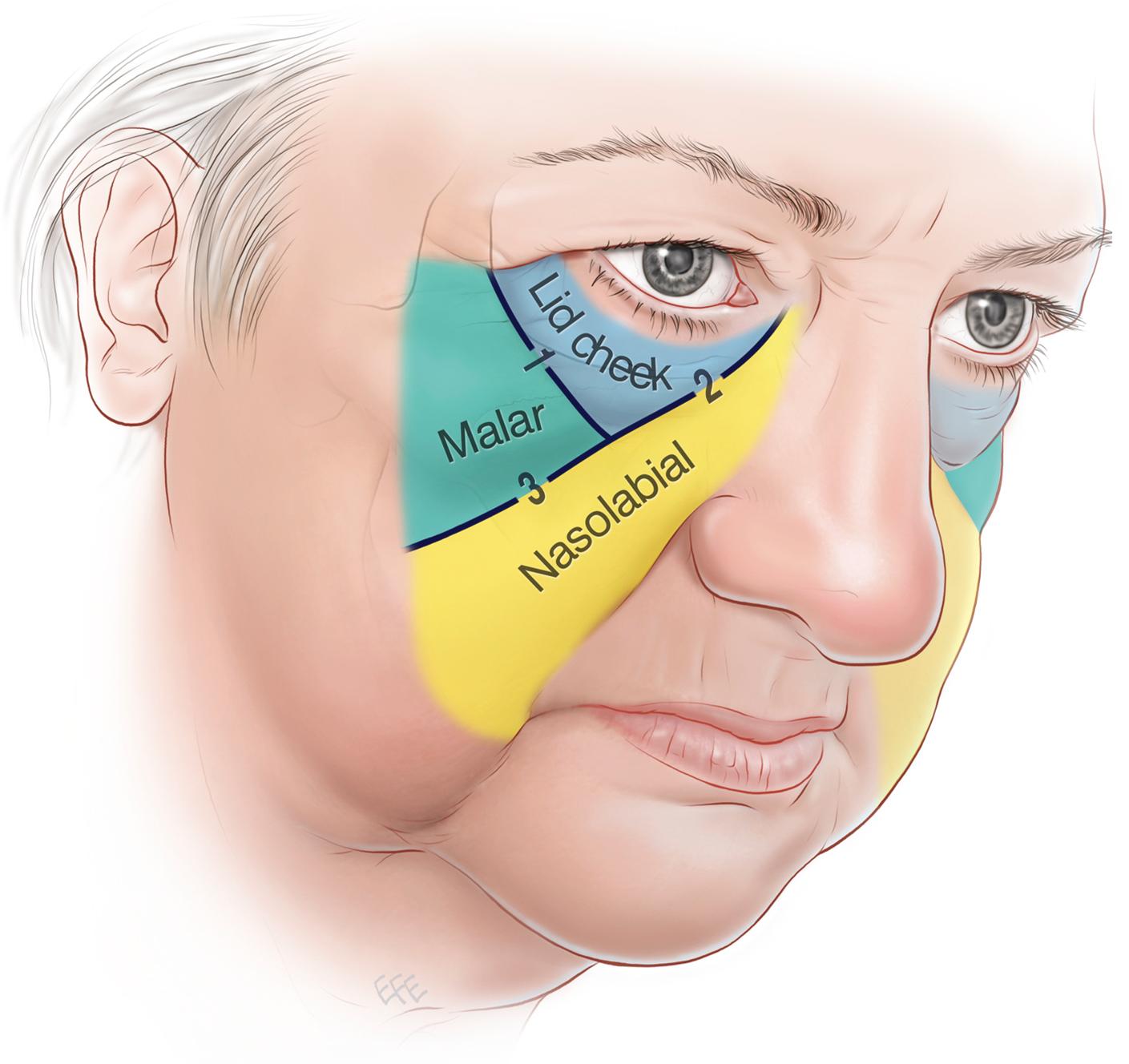 Fig. 28.1, Esthetic subunits of the cheek, separated by 1 , palpebromalar groove; 2 , nasojugal groove; 3 , midcheek furrow.