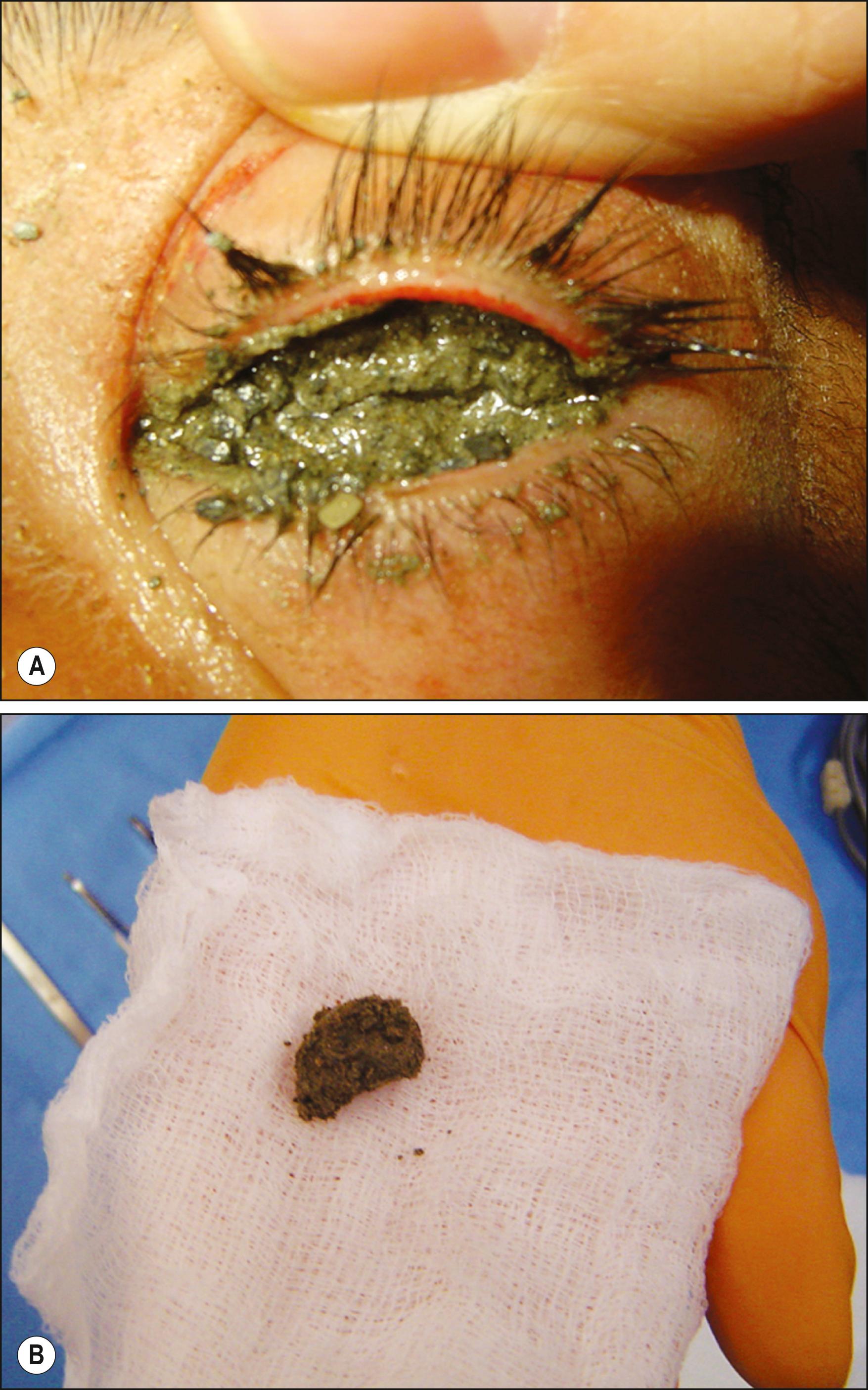 Fig. 95.1, A patient who sustained a severe chemical eye injury from a high-pressure concrete hose, leaving the whole anterior segment encased ( A ) in solidified concrete ( B ).