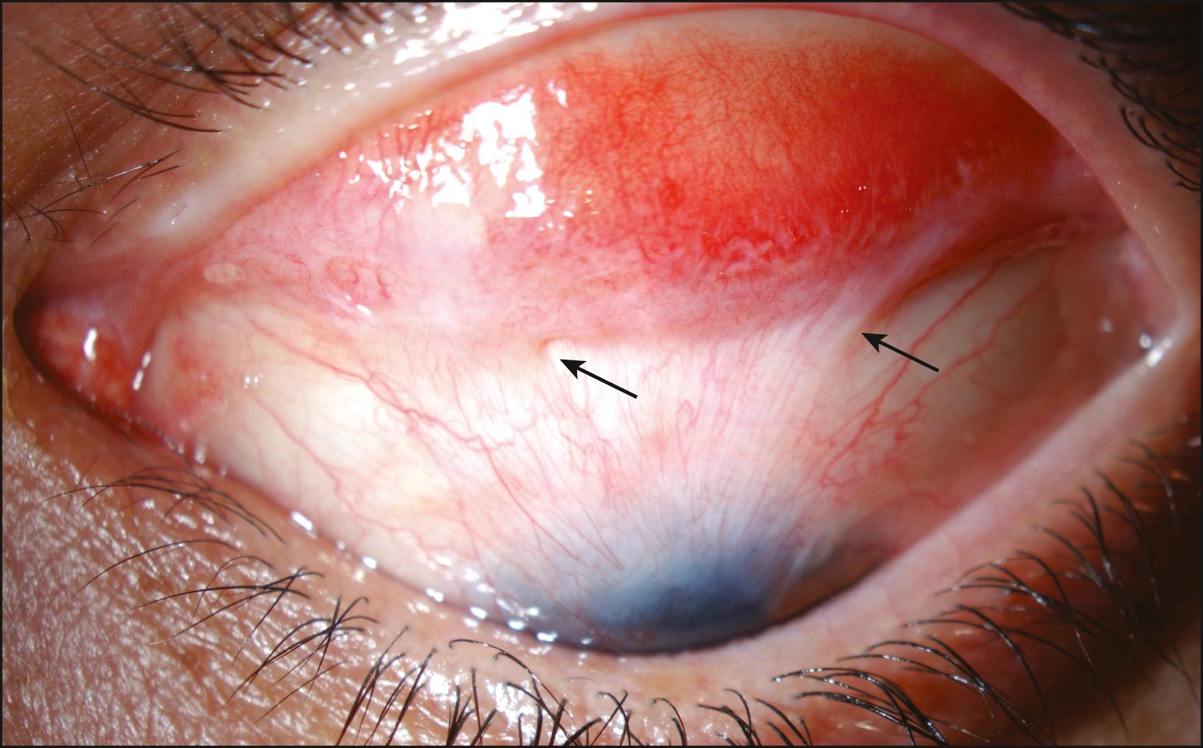 Fig. 95.3, Symblepharon (arrows) involving the superior forniceal conjunctiva.