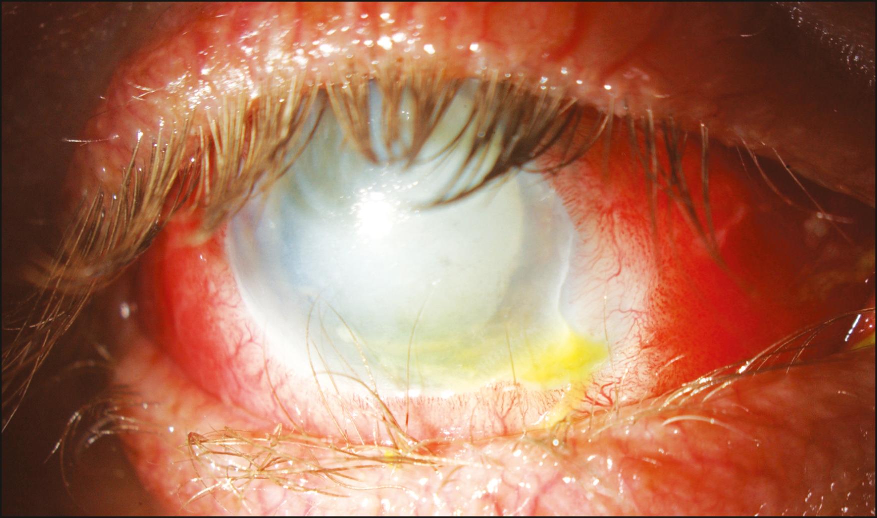 Fig. 95.4, Trichiasis occurring as a sequela of a combined thermal and chemical injury.