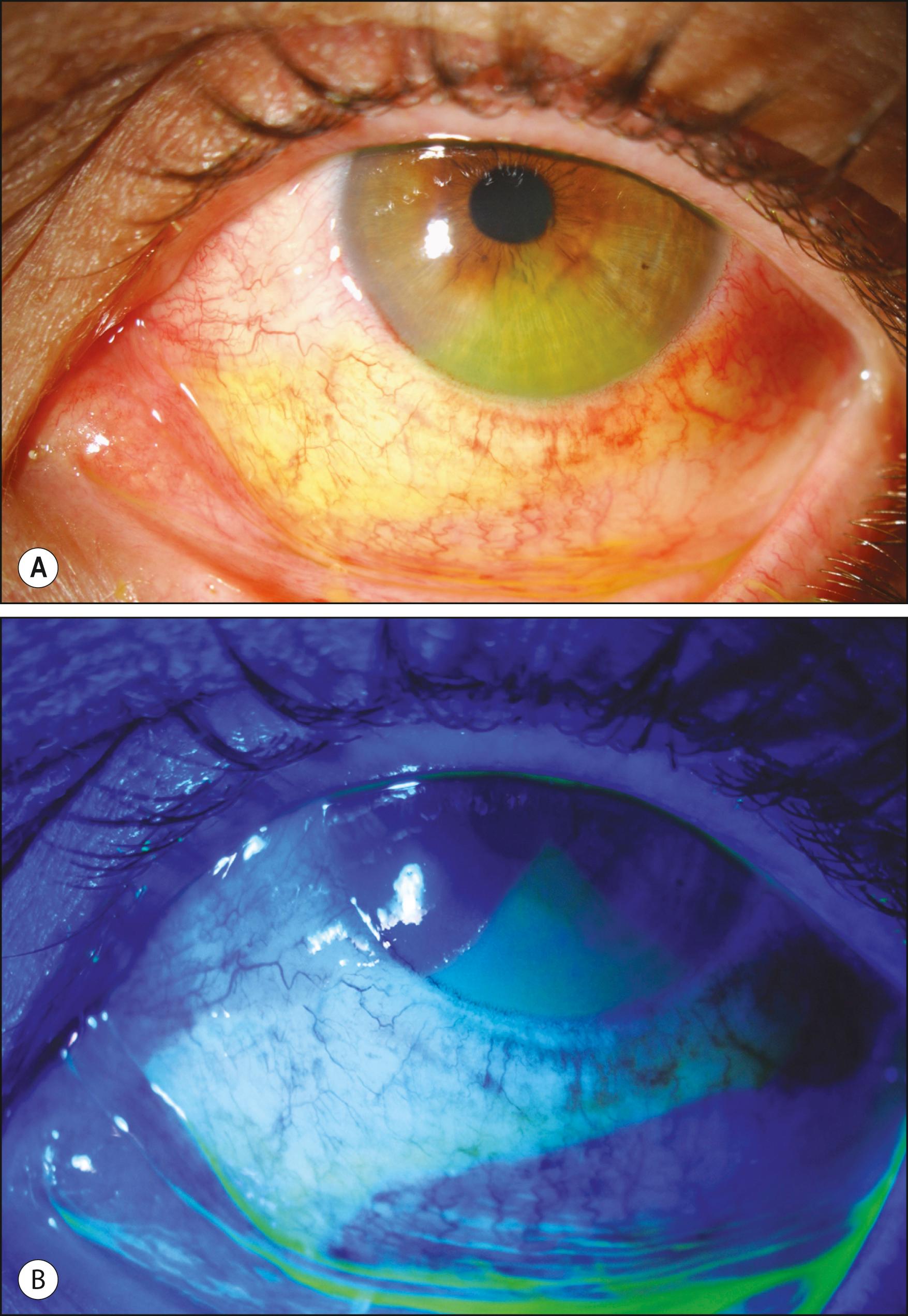 Fig. 95.5, A mild chemical injury resulting in a focal corneal epithelial and conjunctival defect and conjunctival hyperemia ( A ). Fluorescein staining demonstrates epithelial defect ( B ).