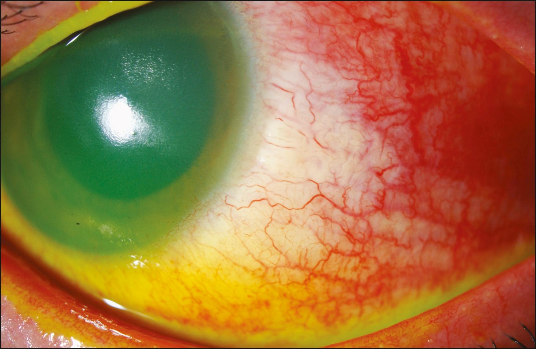 Fig. 95.6, A moderate chemical injury resulting in three clock hours of limbal ischemia.