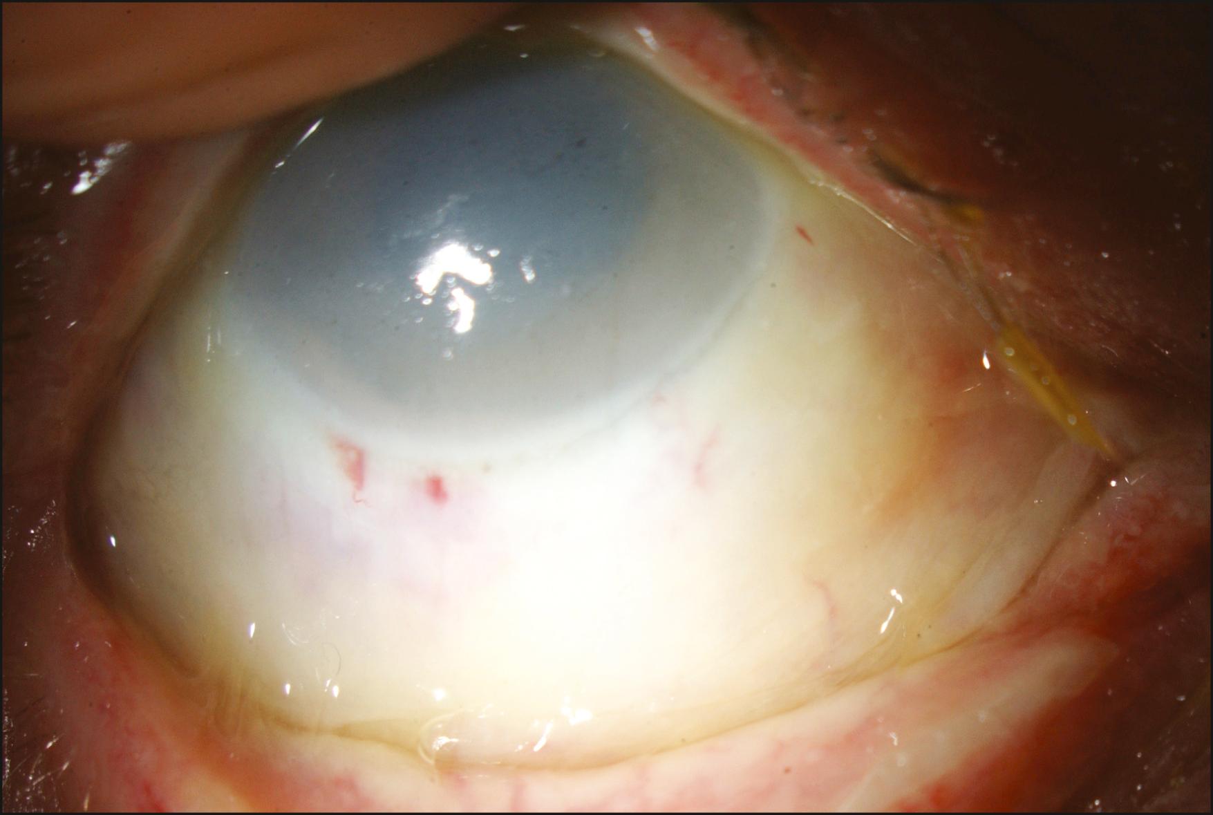 Fig. 95.7, A severe chemical injury with diffuse limbal and conjunctival ischemia and corneal edema.