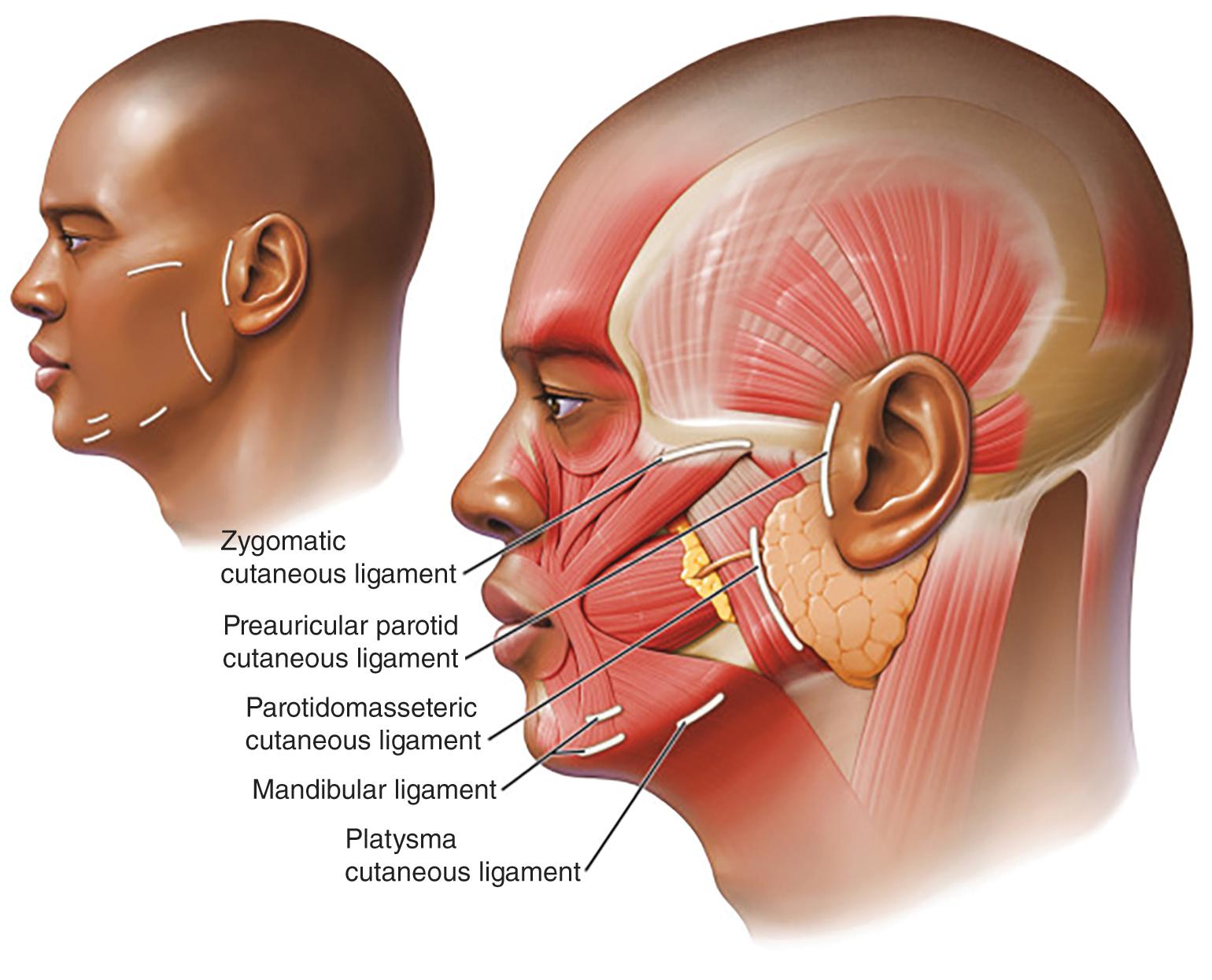 Fig. 3.3, Retaining ligaments of the face relevant to facelift surgery.