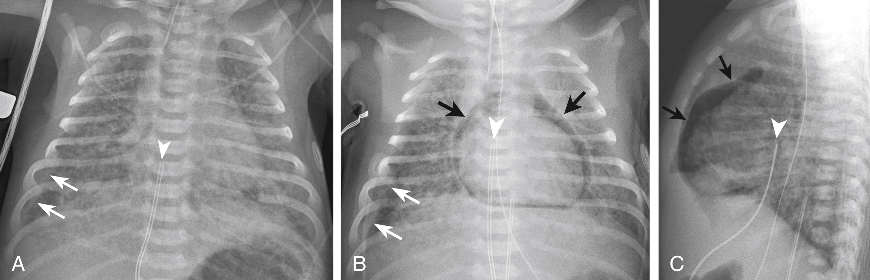 Figure 3-1, Meconium aspiration syndrome.