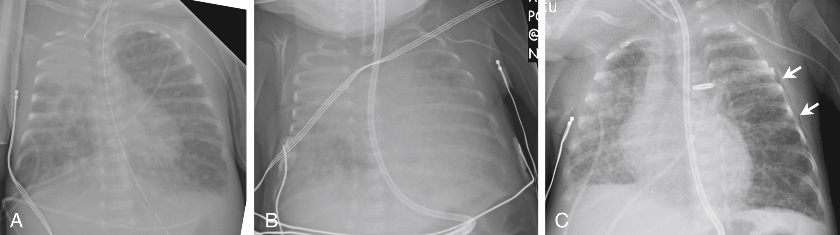 Figure 3-11, Patent ductus arteriosus (PDA) leading to congestive heart failure in a 1-month-old premature.