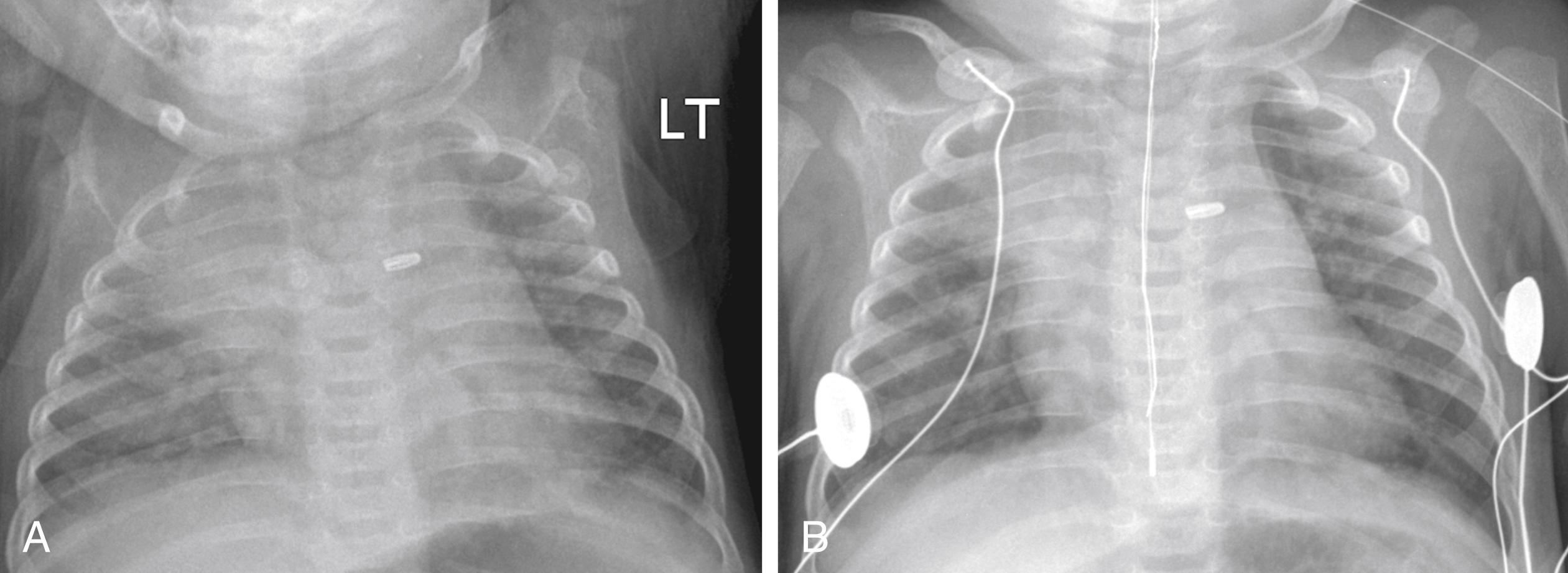 Figure 3-12, Expiratory chest radiograph mimicking heart failure in infant.