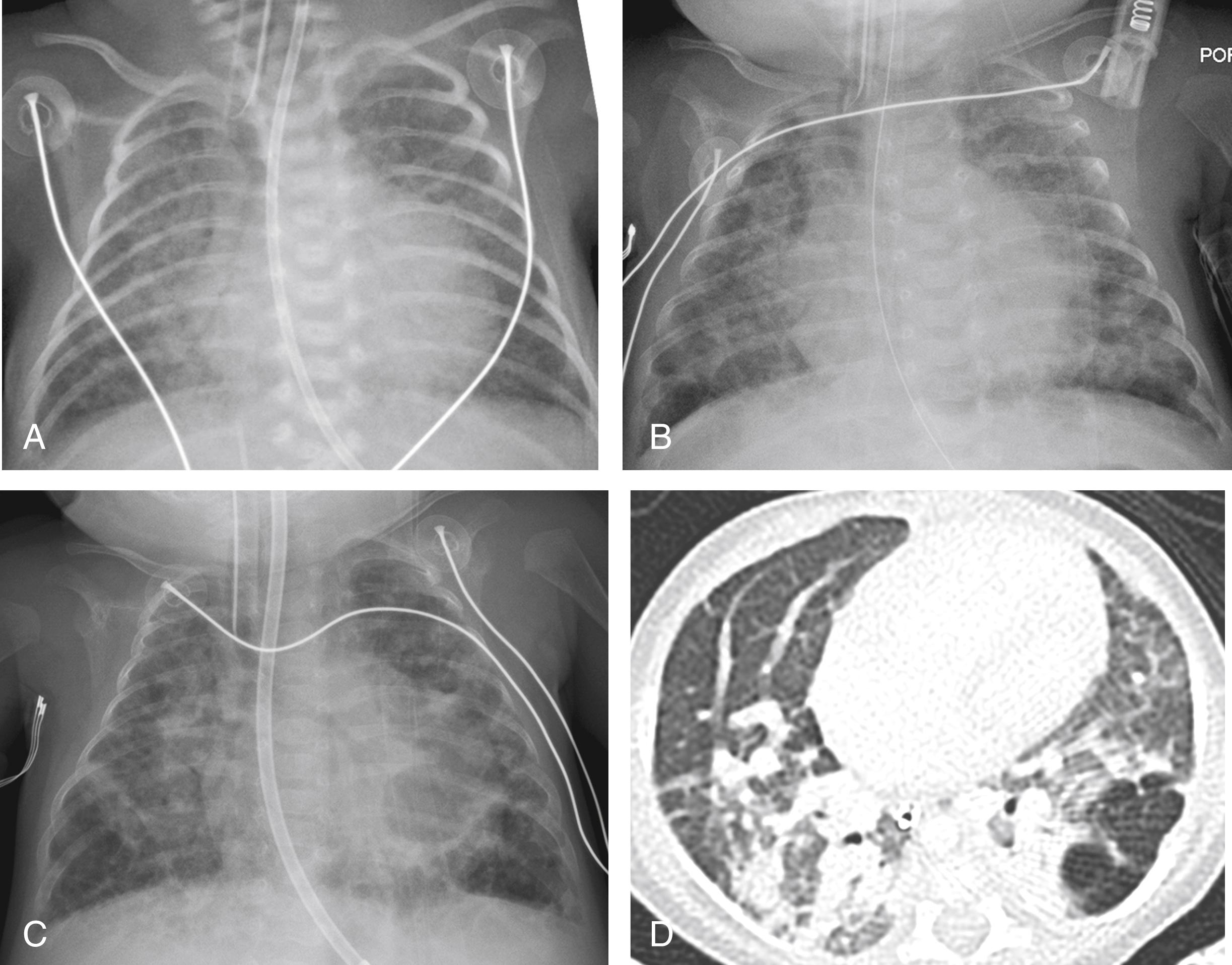 Figure 3-13, Bronchopulmonary dysplasia in a premature girl.