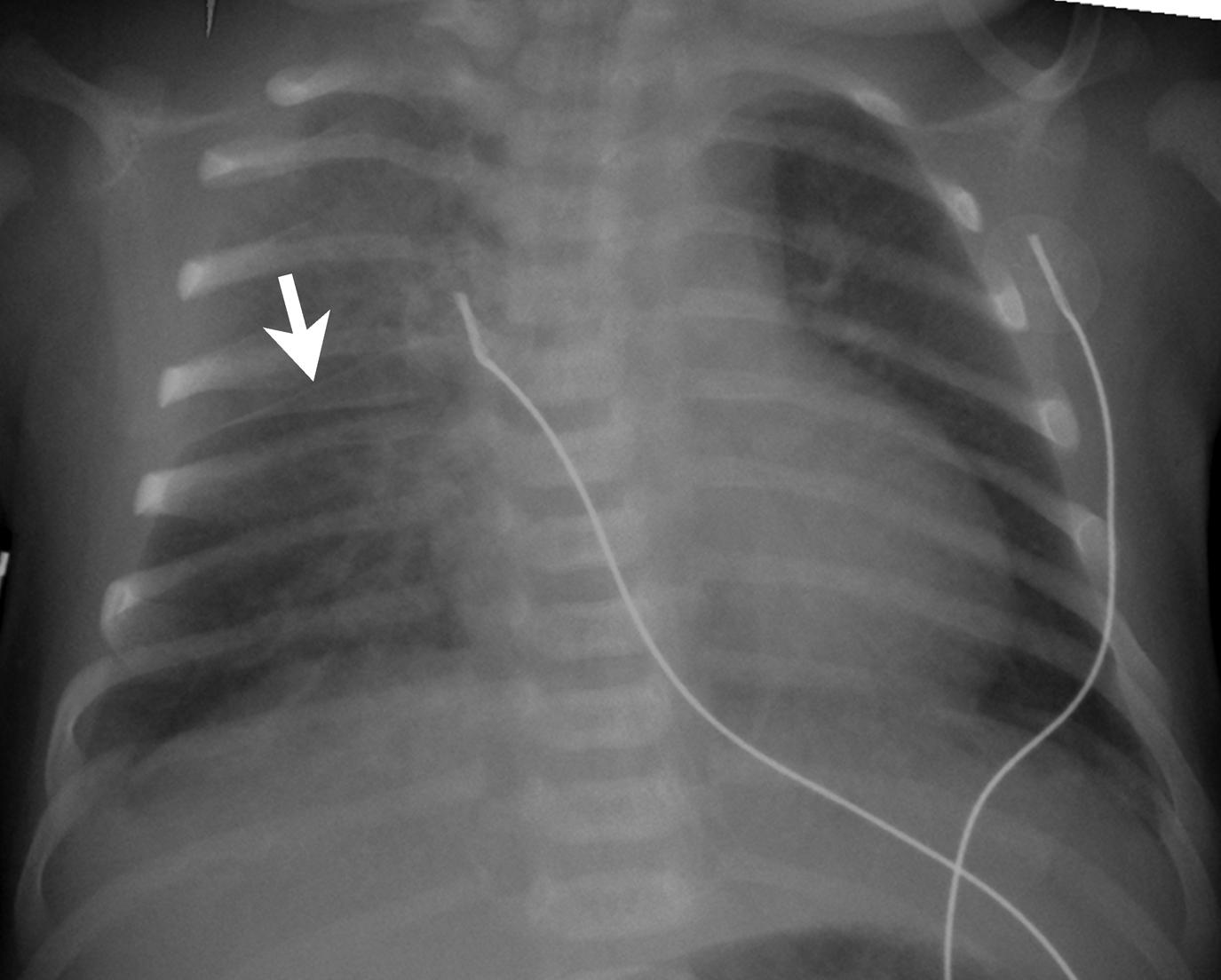 Figure 3-2, Transient tachypnea of the newborn.