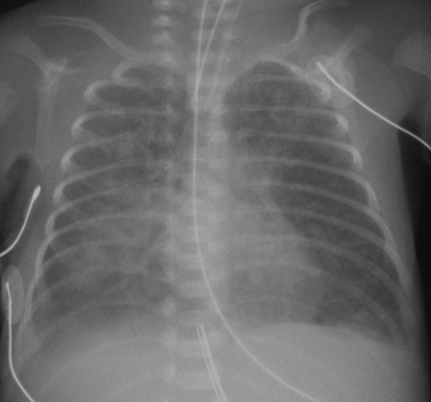 Figure 3-3, Neonatal pneumonia.