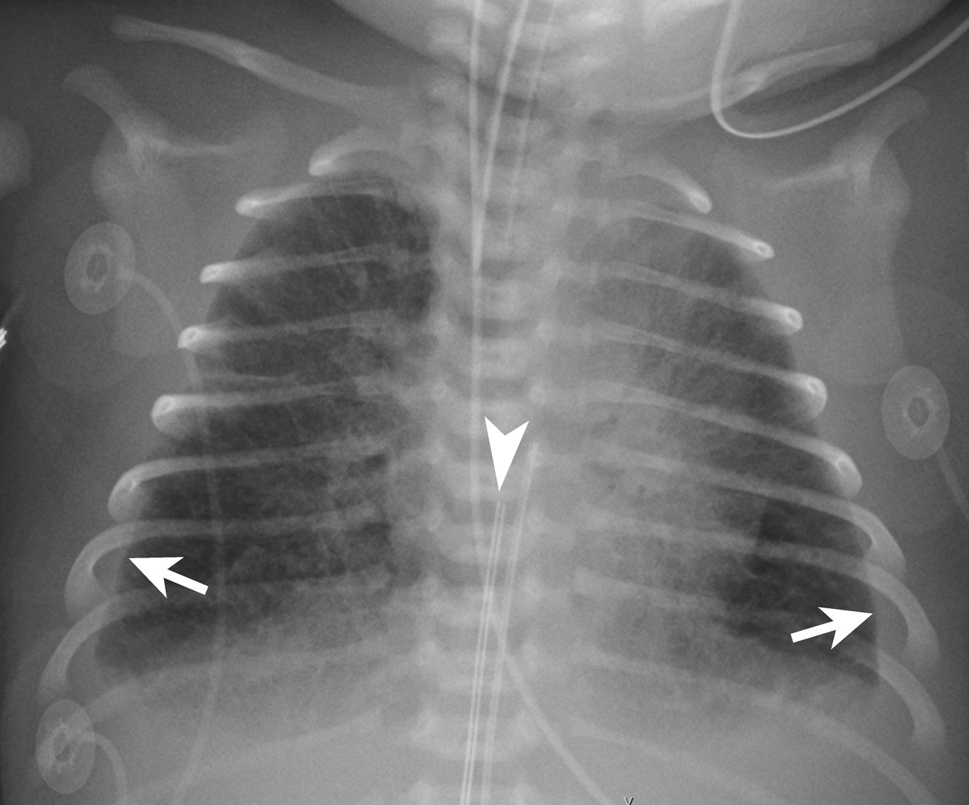 Figure 3-4, Neonatal pneumonia.