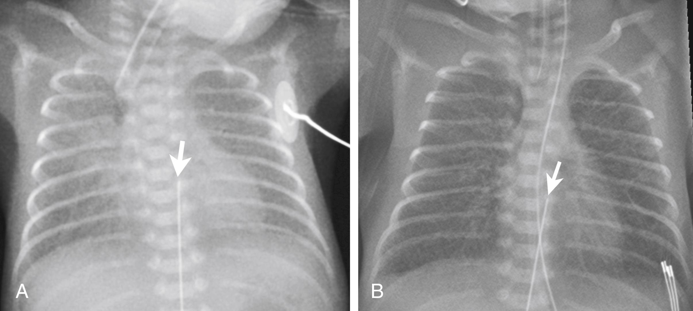 Figure 3-5, SDD responding to surfactant therapy.