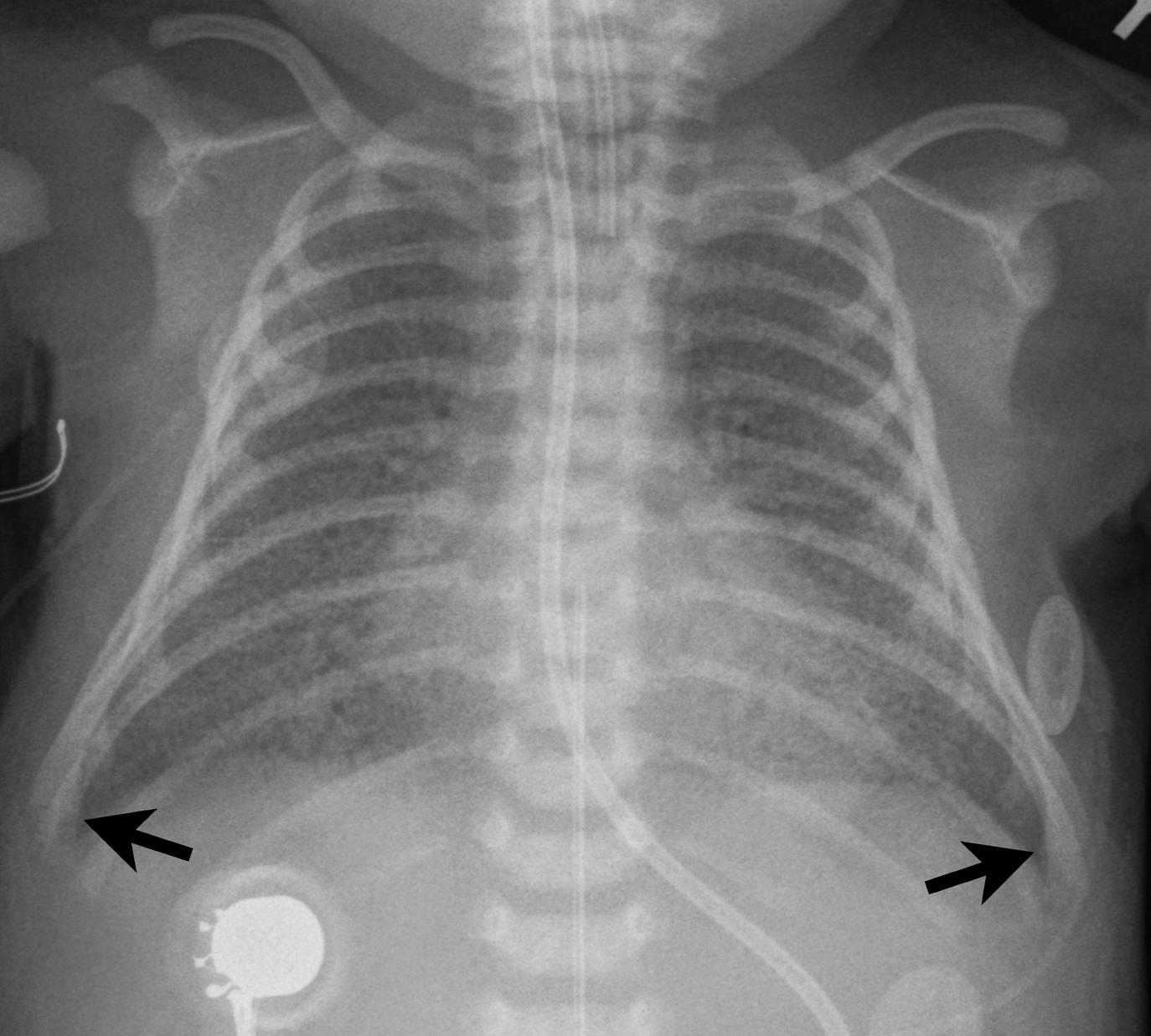 Figure 3-6, Group B streptococcal pneumonia.