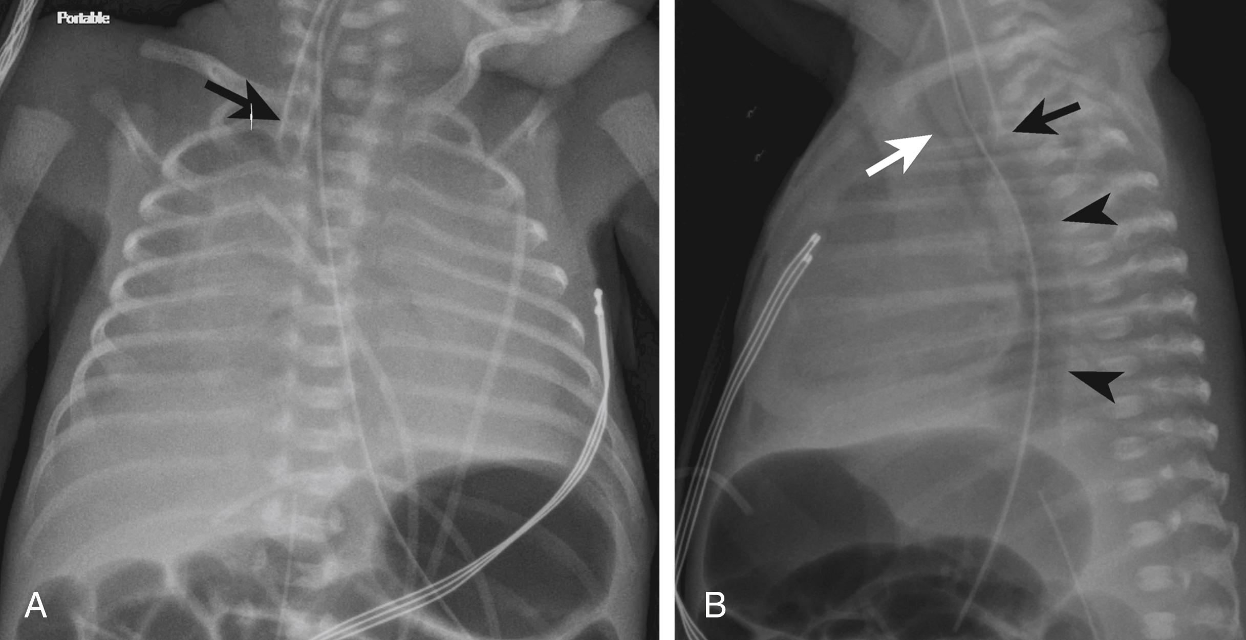 Figure 3-7, Esophageal intubation in a 7-day-old.