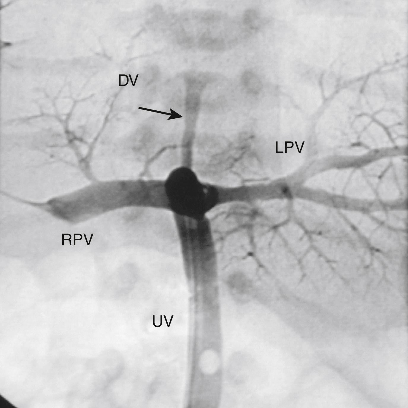 Figure 3-8, Anatomy of the course of the umbilical vein ( UV ) catheter as demonstrated by contrast injection of umbilical catheter performed because of inability to advance UV catheter.