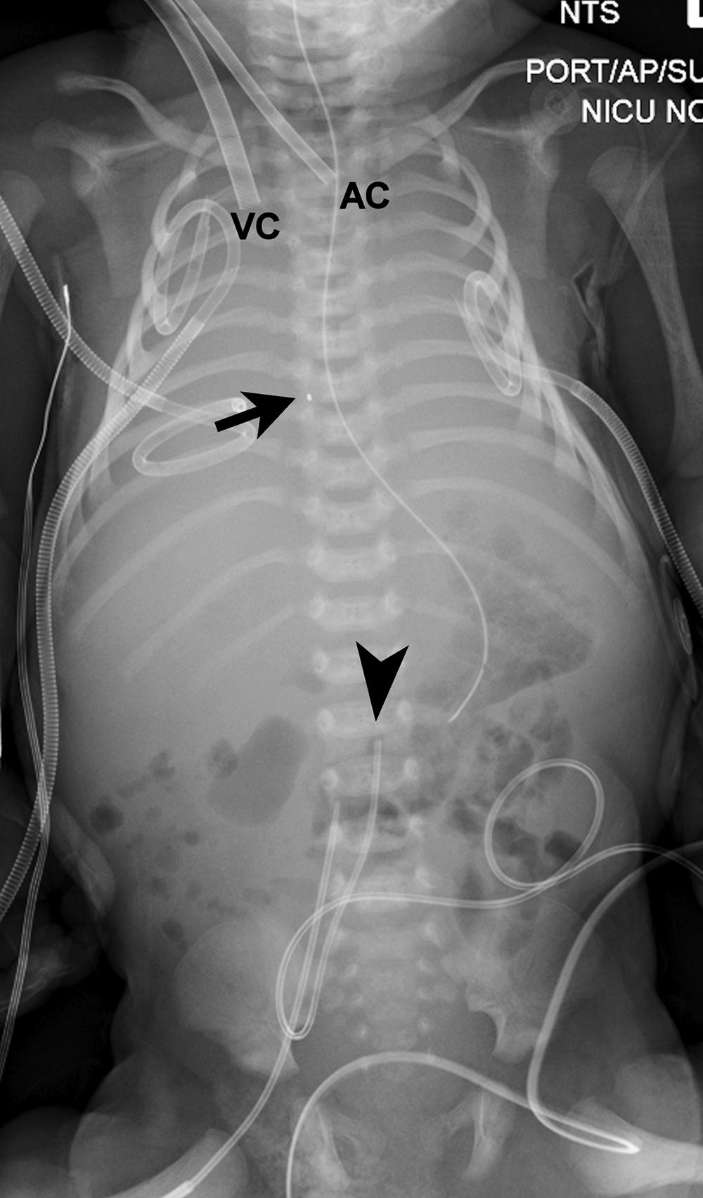 Figure 3-9, Extracorporeal membrane oxygenation (ECMO) catheter placement for meconium aspiration syndrome and persistent air leak.