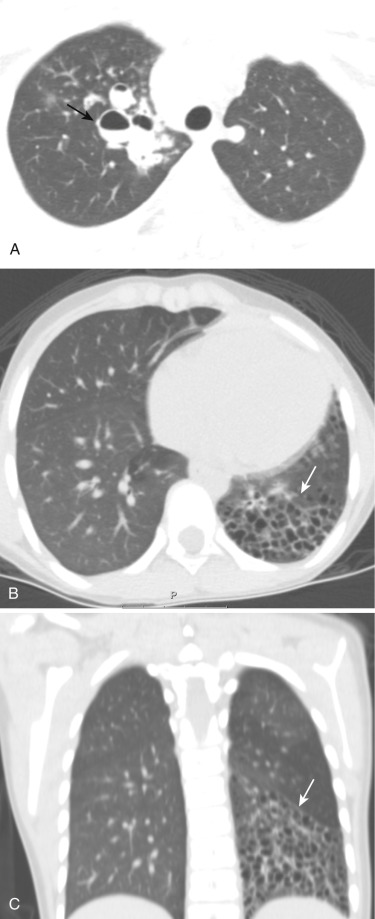 FIG 41-1, Cystic adenomatoid malformation. A, Axial CT shows large cystic spaces filled partially with fluid in the medial aspect of the right upper lobe. B, Axial CT shows multiple small cystic lesions in the left lower lobe in type 2 CPAM. C, Coronal CT in same patient shows multiple small cystic lesions in the left lower lobe.