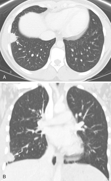 FIG 41-11, Round pneumonia. A, Axial CT shows a well-defined round area of consolidation in the periphery of the right lower lobe (arrow) in a 7-year-old boy. B, Coronal CT in the same patient shows the well-defined round pneumonia in the right lower lobe (arrow).