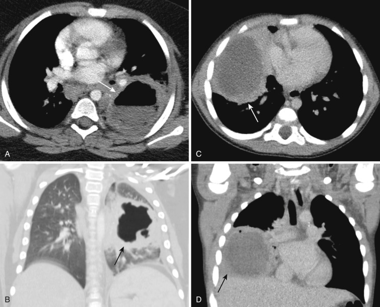 FIG 41-12, Pneumonia with lung abscess formation. A, Axial CT shows a large irregular gas-containing cavitary lesion in the left lower lobe (arrow) consistent with a lung abscess. B, Coronal CT shows a large thick-walled abscess cavity in the left lower lobe (arrow) with surrounding areas of consolidation. C, Axial CT in another patient shows a large fluid-containing lesion in the right lung (arrow) with thick walls and surrounding consolidation, consistent with lung abscess. D, Coronal CT shows a large thick-walled cavitary lesion with gas bubbles (arrow) consistent with a lung abscess.