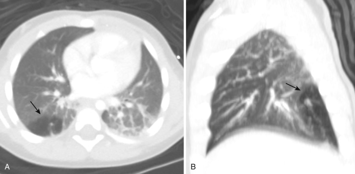 FIG 41-2, Congenital lobar emphysema. A, Axial CT shows hyperinflation of the posterior segment of the right lower lobe in a patient with congenital lobar emphysema. B, Sagittal CT in the same patient shows lucency and hyperinflation of the posterior segment of the right lower lobe.