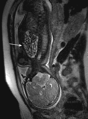 FIG 41-3, Congenital diaphragmatic hernia. Single-shot coronal T2-weighted MRI of an approximately 28-week fetus reveals nondilated bowel filling the left hemithorax. The left lung was hypoplastic. Mediastinum was shifted rightward. Patient received surgery soon after birth.